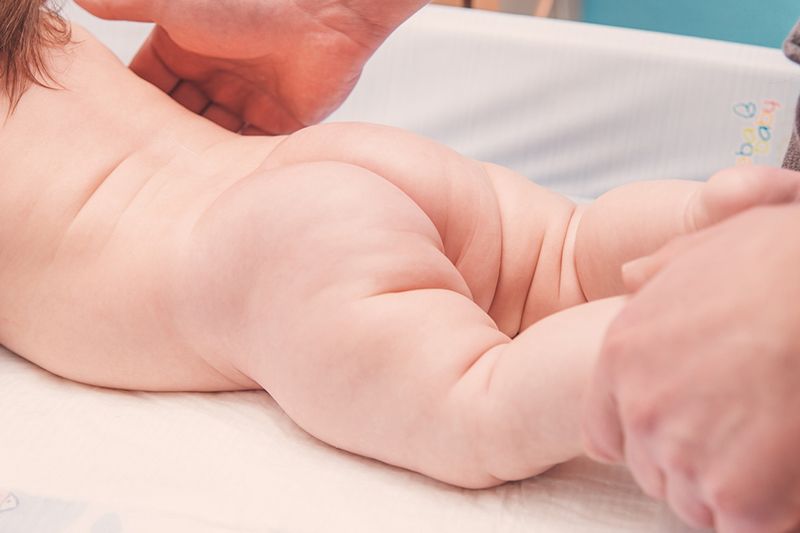 babys list Scalds in Babies: Diaper Discomfort