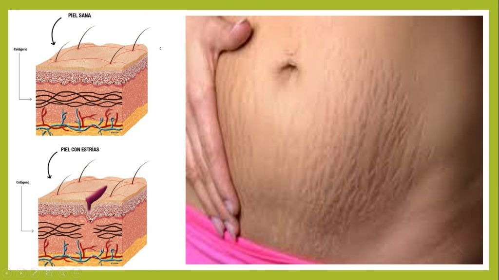 Get rid stretch marks