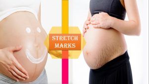 Get rid stretch marks